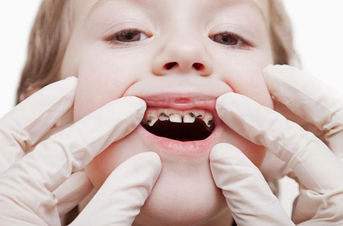 Uşaqlarda diş çürümələri niyə artıb?